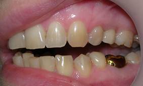 Описание: зуб замещен металлокерамической коронкой на имплантате.