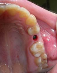 Описание: имплантат вместо утраченного зуба