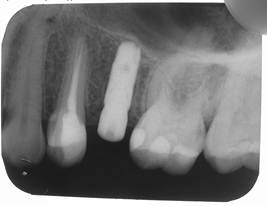 Описание: имплантация - лучший метод замещения одного зуба.