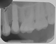 Описание: контрольный ренгеновский снимок через год после имплантации зуба.