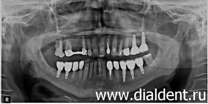 Панорамный снимок для контроля кости после имплантации зубов. Пациенту Диал-Дент 70 лет.