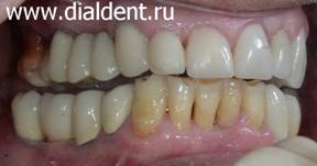 фото после зубной имплантации и протезирования на имплантах.
