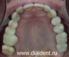 Металлокерамические коронки фиксированы к зубным иплантам. Функция восстановлена. Пациенту 70 лет!