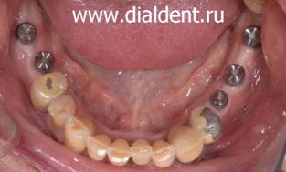 Пять зубных имплантов установлены в нижнюю челюсть, два в верхнюю. Пациенту Центра "Диал-Дент" 70 лет