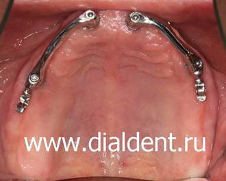К зубным имплантам Astra Tech прикучены болки посредством которых зубной протез будет удерживаться во рту неподвижно