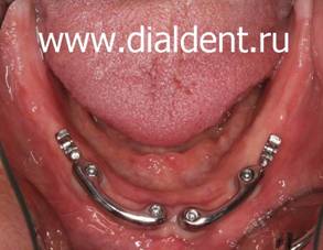 Протезирование зубов на имплантах в Стоматологической клинике "Диал-Дент"
