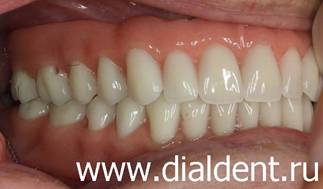 Фото протезов на зубных имплантам справа. Клиника Диал-Дент