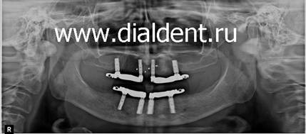 Контрольный панорамный снико зубов. Выполняется в стоматологичесмкой клинике "Диал-Дент" при протезировании на имплантах.