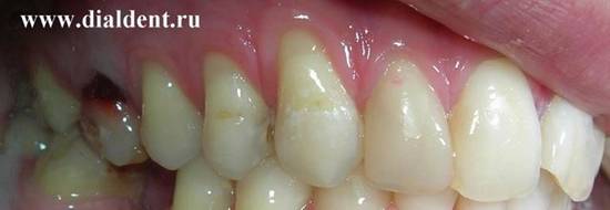 Темные зубы. Коричневые зубы. Лечение. Реставрация
