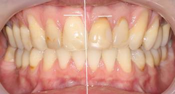 Эстетический анализ и расчеты реставрации зубов керамическими винирами.