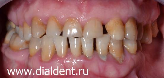 Зуб до лечения в Диал-Дент. Стираемость зубов, сколы зубов, желто-коричневые зубы.