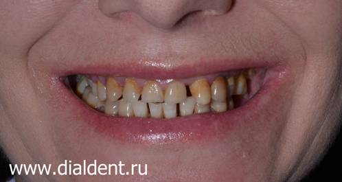 Желто-коричневые темные зубы не украшают улыбку. Щели между зубами и сколы зубов не украшают улыбку женшины