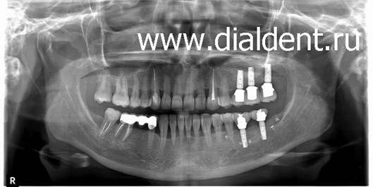 На панорамном снимке зубов видны импланты зубные в количестве пяти штук