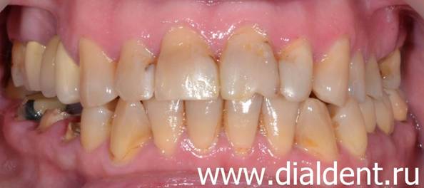 Фото зубов ДО протезирования зубов и имплантации в Центре "Диал-Дент"