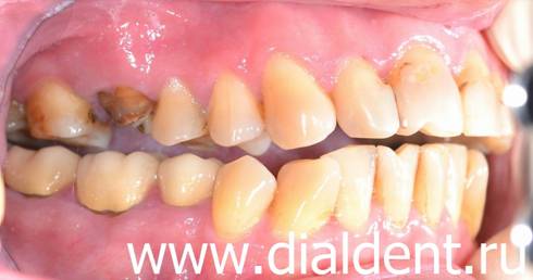 Один зуб черный, гниет и восстановлению не подлежит. Будет заменен на имплант зубной в Центре "Диал-Дент"