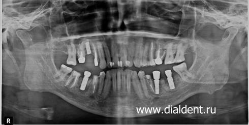Зубные имплнаты видны на понорамном снимке зубов