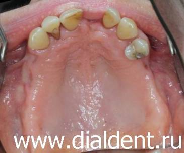 Лечение пародонтита в Центре "Диал-Дент" стоматологическим лазером.