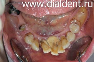 Фото - результаты действия тяжолого пародонтита. Гнилые зубы, расшатанные зубы, выпавшие зубы.