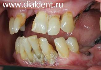 Пародонтит - грозное инфекционное заболевание десен при котором зуб может полностью выпатьс из челюсти.