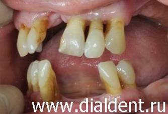 Оголения корней зубов в результате пародонтита. После лечения часто оголение увеличивается в результате уменьшения объемов десны после снятия воспаления.