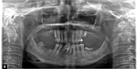 План лечения всегда пишется с применением панорамного снимка зубов или компьютерной томографии.