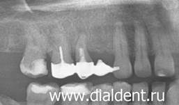 Промежуток от отсутствуюшего зуба закрыт местовидным протезом