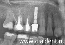 Зубной имплант установлен