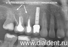 Кривые каналы зубов вылечены с применением микроскопа