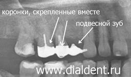 Металлопластмассовые коронки на зубах связаны вместе в мостовидный протез