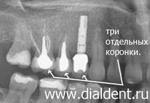 Керамические корокни стоят отдельно, каждая на свем зубе и одна коронка отдельно на зубном импланте