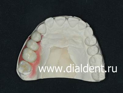 Керамическая коронка на имплант, керамические коронки на свои два зуба и керамическая вкладка на модели в Лаборатории "Диал-Дент"
