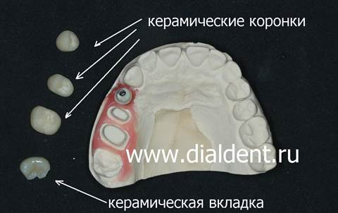 В "Диал-Дент" в этой ситуации мы применили самый современный вид стоматологической керамики - Emax (Германия)