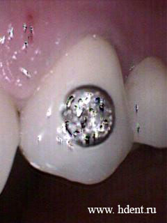 бриллианты в зубах