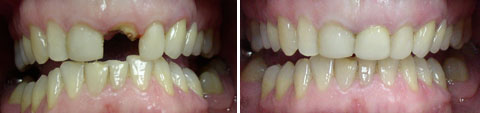 Замещение одного зуба металлокерамической коронкой - работа врача-стоматолога Цукора С.В.