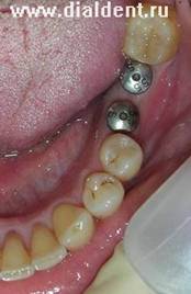 имплантация зубов.