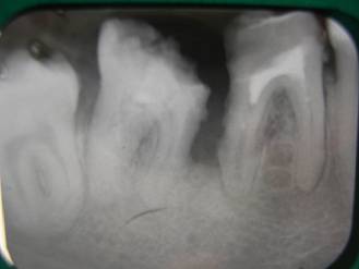 зубы, которые планируется заместить имплантатами.