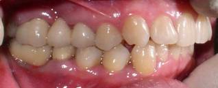 протезирование зубов на имплантатах