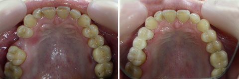микропротезирование зубов - работа выполнена врачом-стоматологом Цукором С.В.