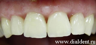 Виниры керамические для четырех передних верхних зубов.
