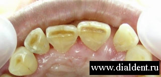 Сколы эмали, стираемость эмали, щели между зубами, трещины эмали
