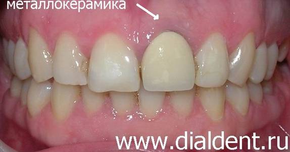 металлокерамическая коронка не самый лучший вариант для реставрации зуба