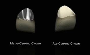 сравнение металлокерамической коронки и керамической коронки