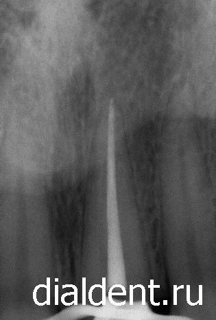 Рентген зуба: зубной штифт удален, канал зуба перелечен с микроскопом. 
