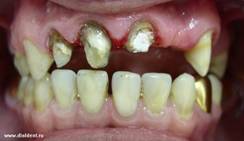 предстоит протезирование зубов