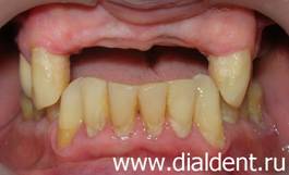 Зубы до протезирования зубов