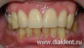 Бюгельный протез, сделан в Центре "Диал-Дент" является альтарнативой имплантации зубов