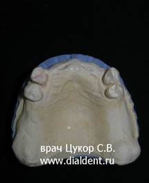 Модель челюсти пациента. Делается для тщательного планирования бюгельного протеза.