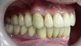 На верхней челюсти осталось только два зуба. Остальные зубы съемные