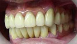 На верхней челюсти осталось только два зуба. Остальные зубы съемные.