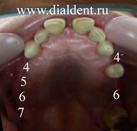 Описание: Бюгельный протез заместит шесть отсутствующих зубов верхней челюсти